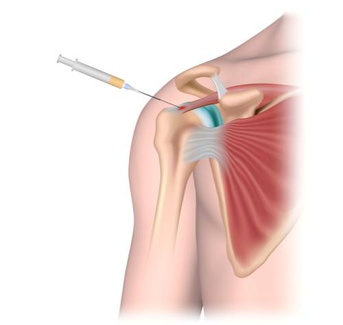 PRP Injections and Physical Therapy